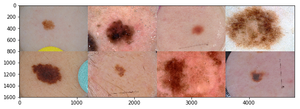 skin lesions